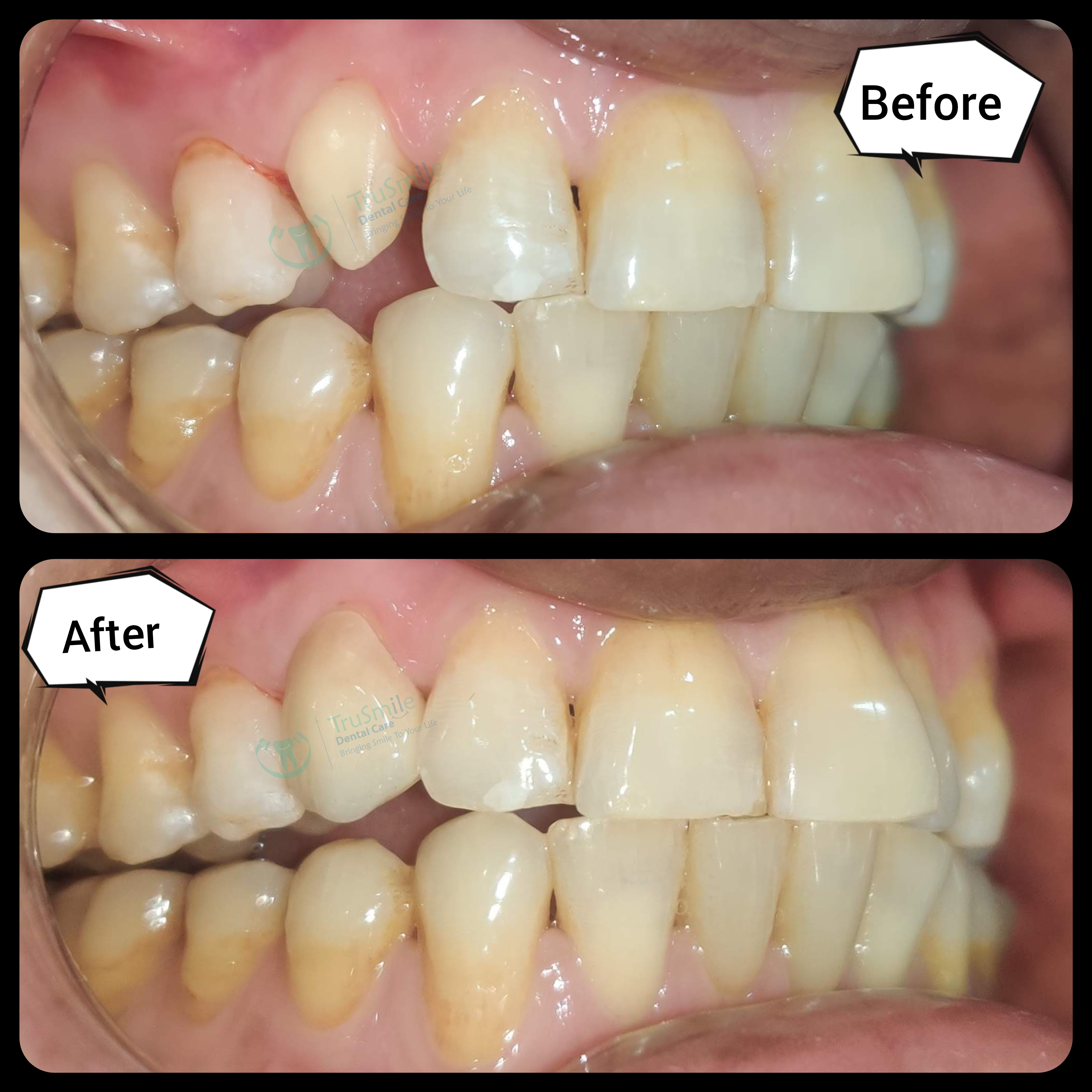 Zirconia 10